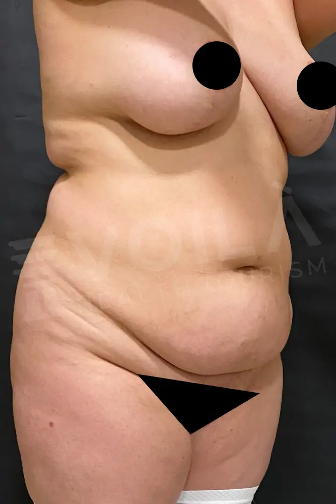 Tummy Tuck - Voila Health Tourism - Dr Furkan Certel