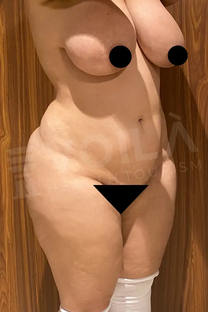 Liposuction - Voila health tourism - dr furkan certel