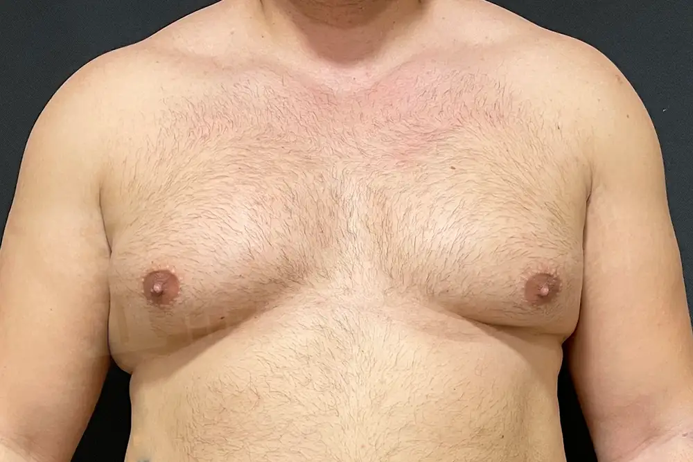 Gynecomasty- Voila Health Tourism