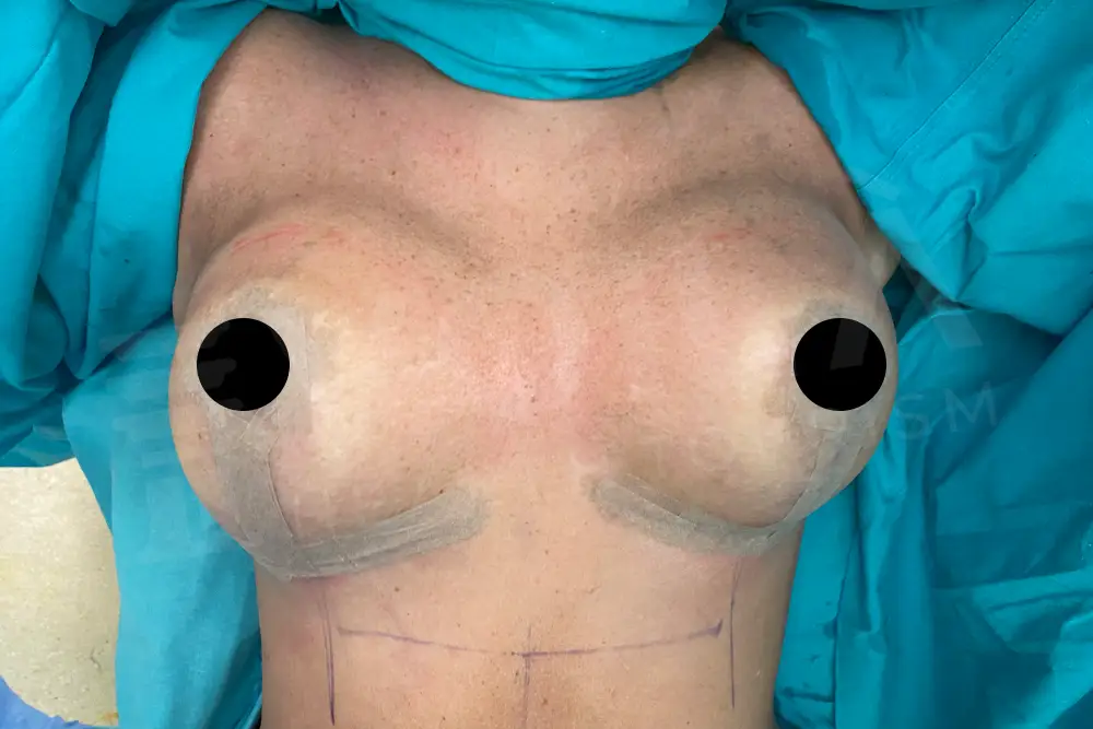 Breast Lift & Implant - Voila Health Tourism - Dr Furkan Certel