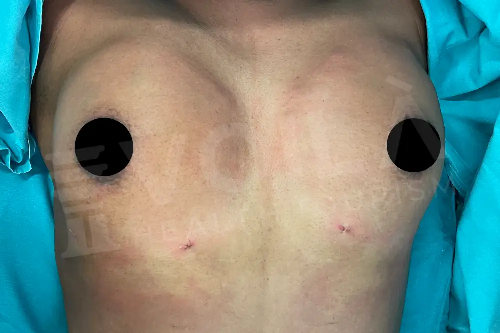 Breast Fat Injection - Voila Clinic - Dr Furkan Certel