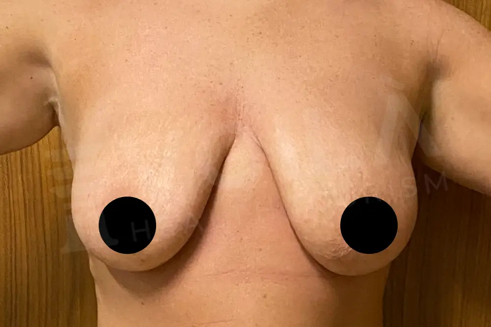 Breast Lift & Implant - Voila Health Tourism - Dr Furkan Certel