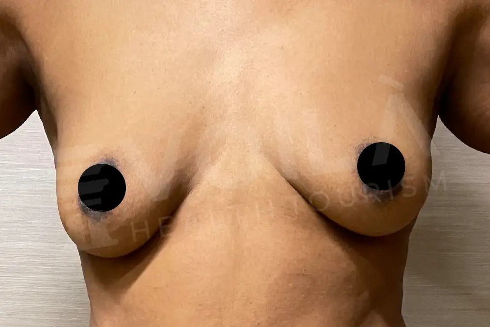 Breast Fat Injection - Voila Clinic - Dr Furkan Certel