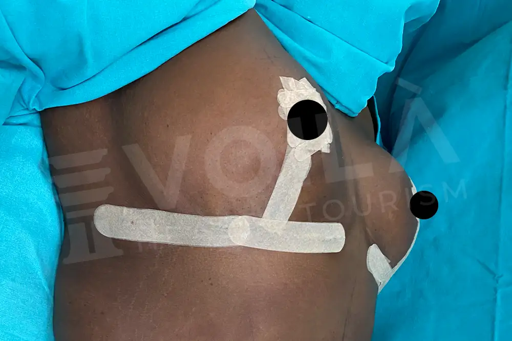 Breast Lift - Voila health tourism - dr furkan certel
