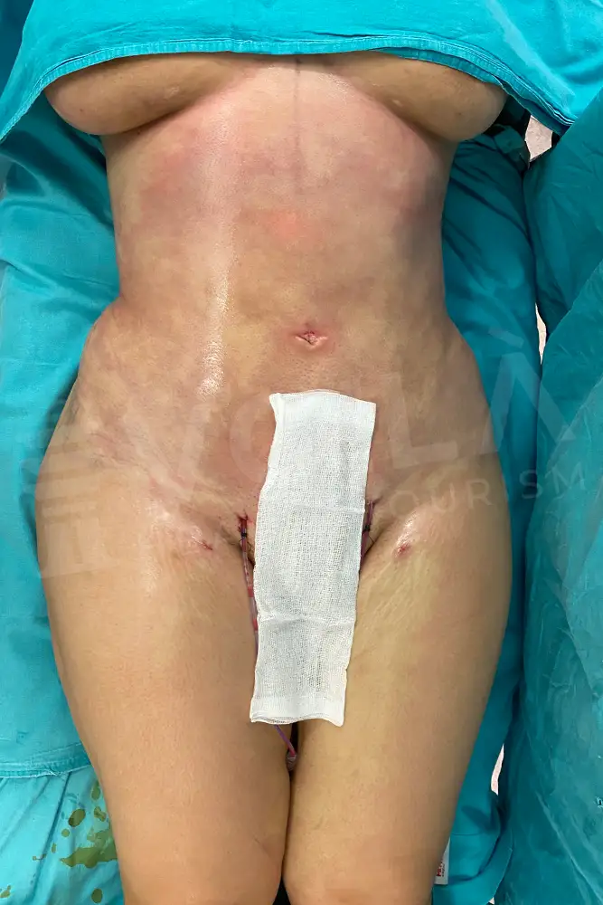 Liposuction - Voila health tourism - dr furkan certel
