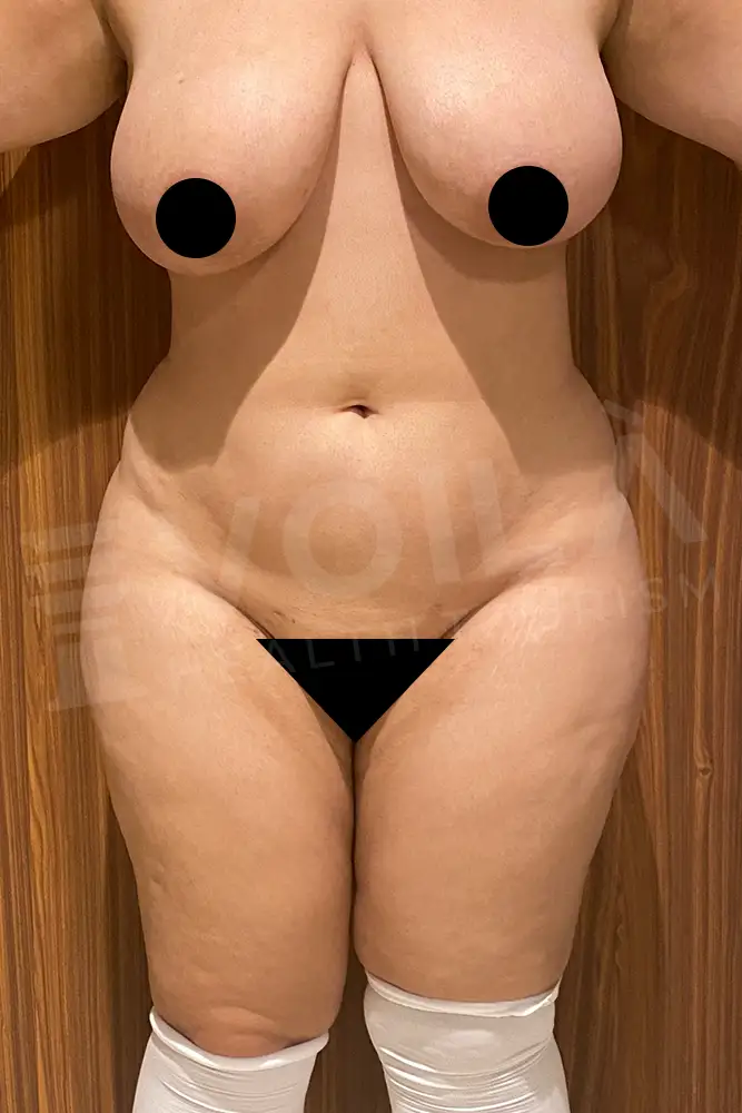 Liposuction - Voila health tourism - dr furkan certel
