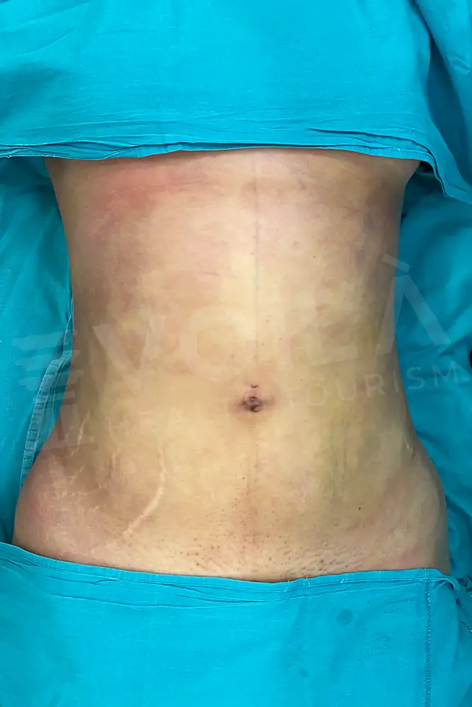 Liposuction - Voila health tourism - dr furkan certel