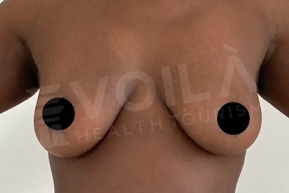 Breast Implant - Voila health tourism - dr furkan certel
